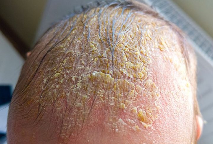Cradle Cap in Babies