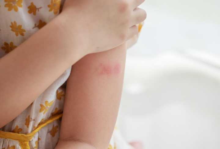 Eczema 2